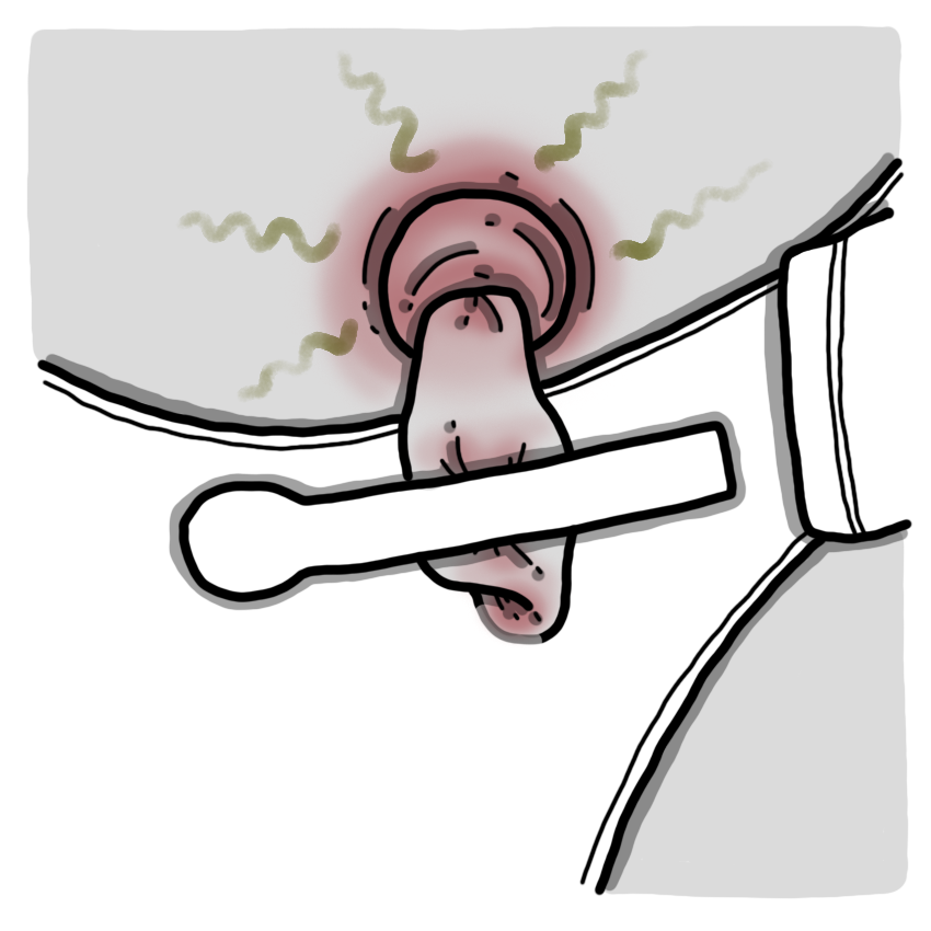 Foul-smelling belly button or umbilical cord