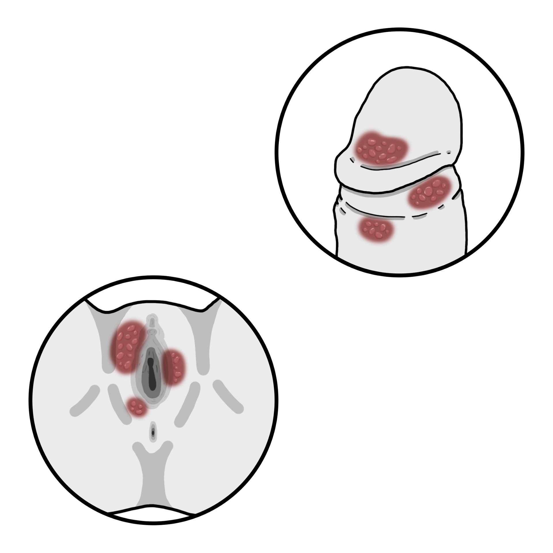 Κύστες στα γεννητικά όργανα που προκαλούν επώδυνα έλκη
