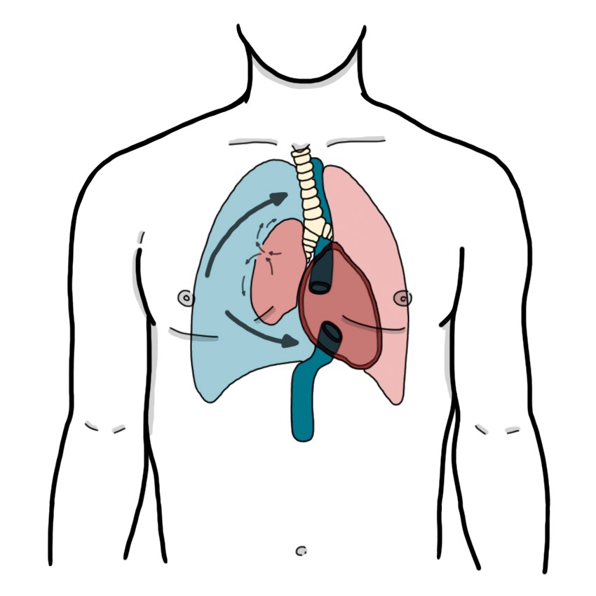 Tension pneumothorax