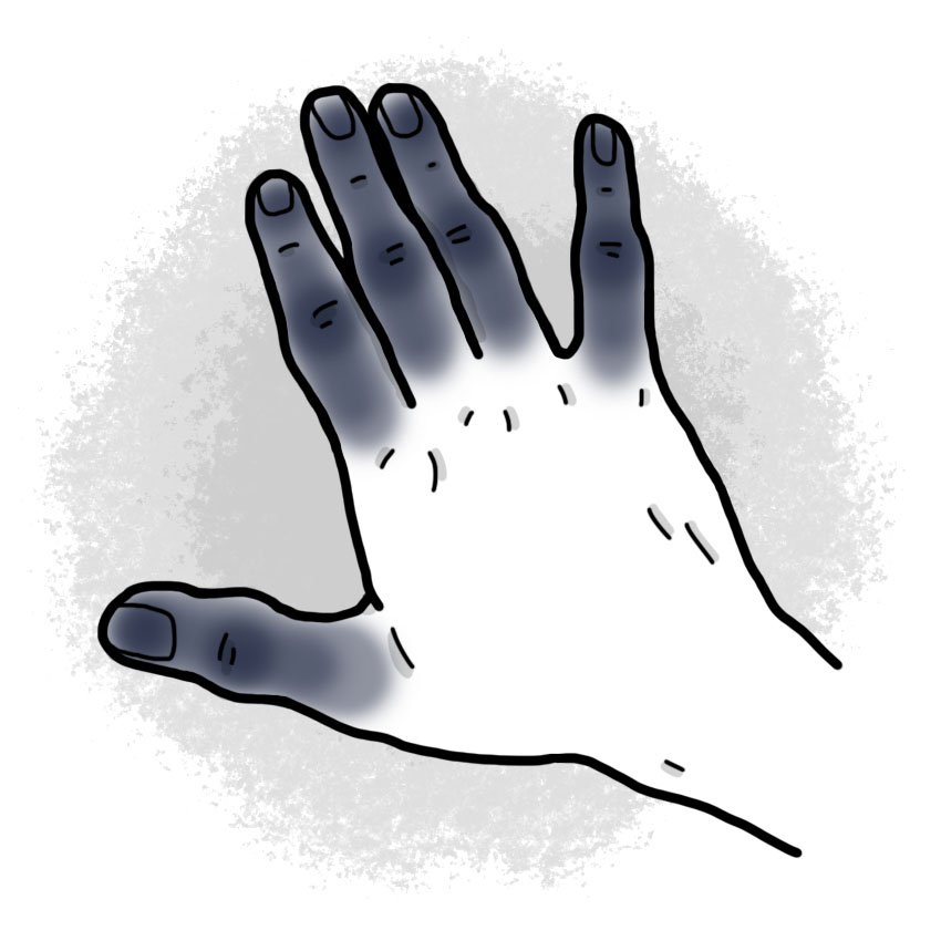 Fourth-degree frostbite