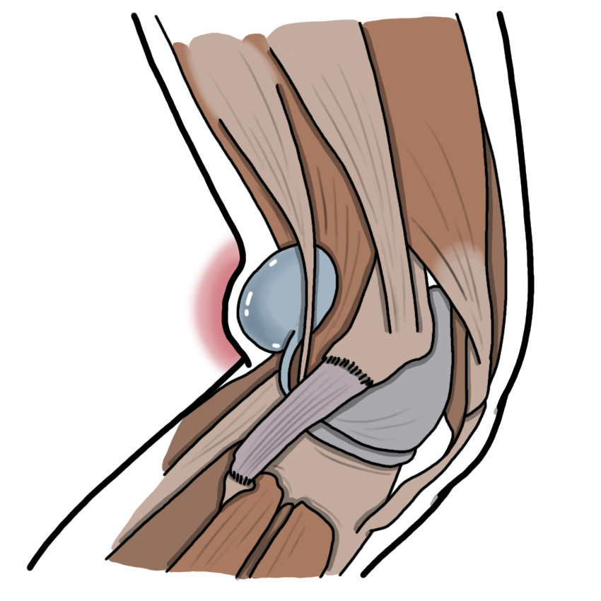 Popliteal cyst - Baker's cyst