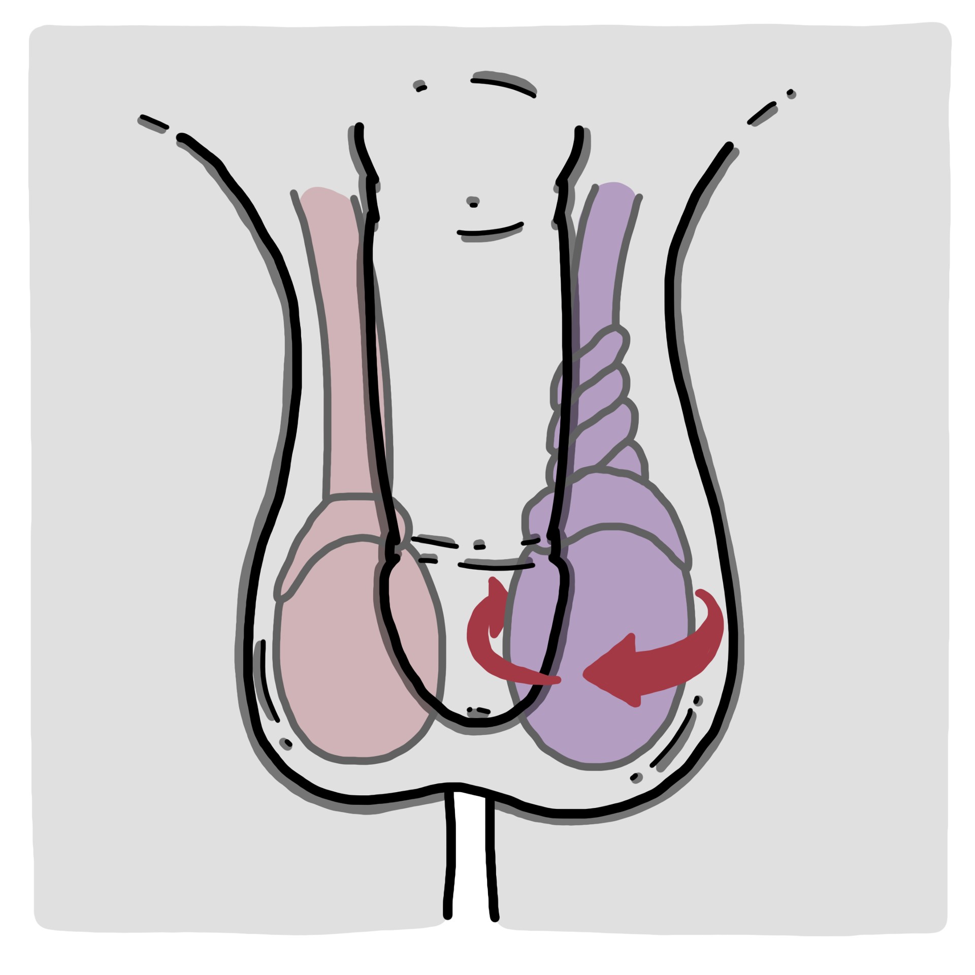 Twisted spermatic cord - Testicular torsion