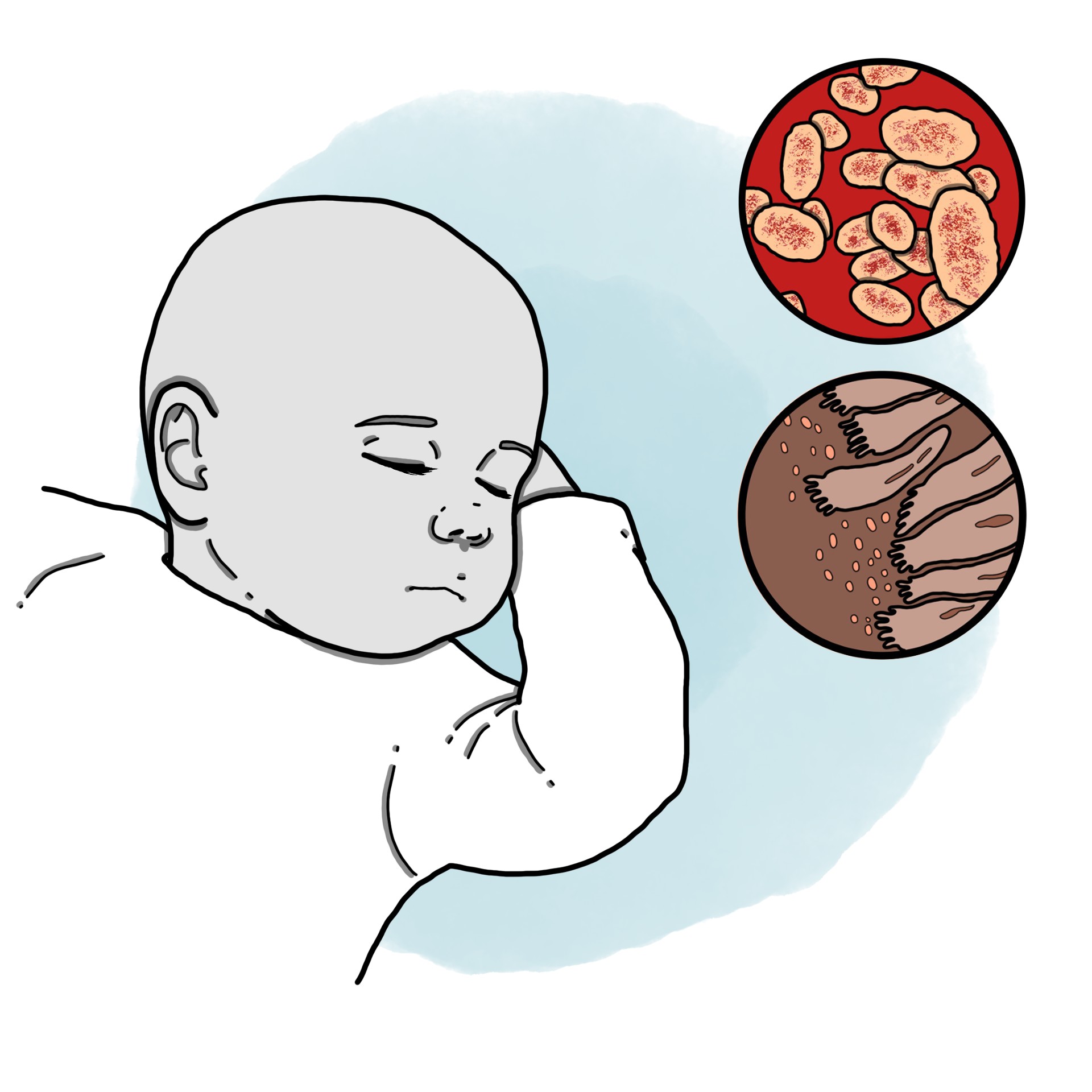 Whooping cough in infants (Paediatrics)
