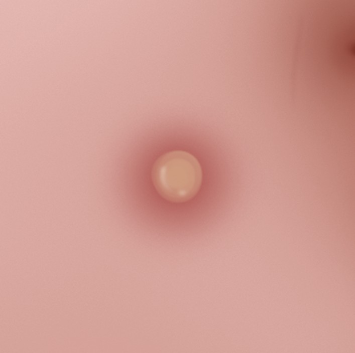 Pústula/es