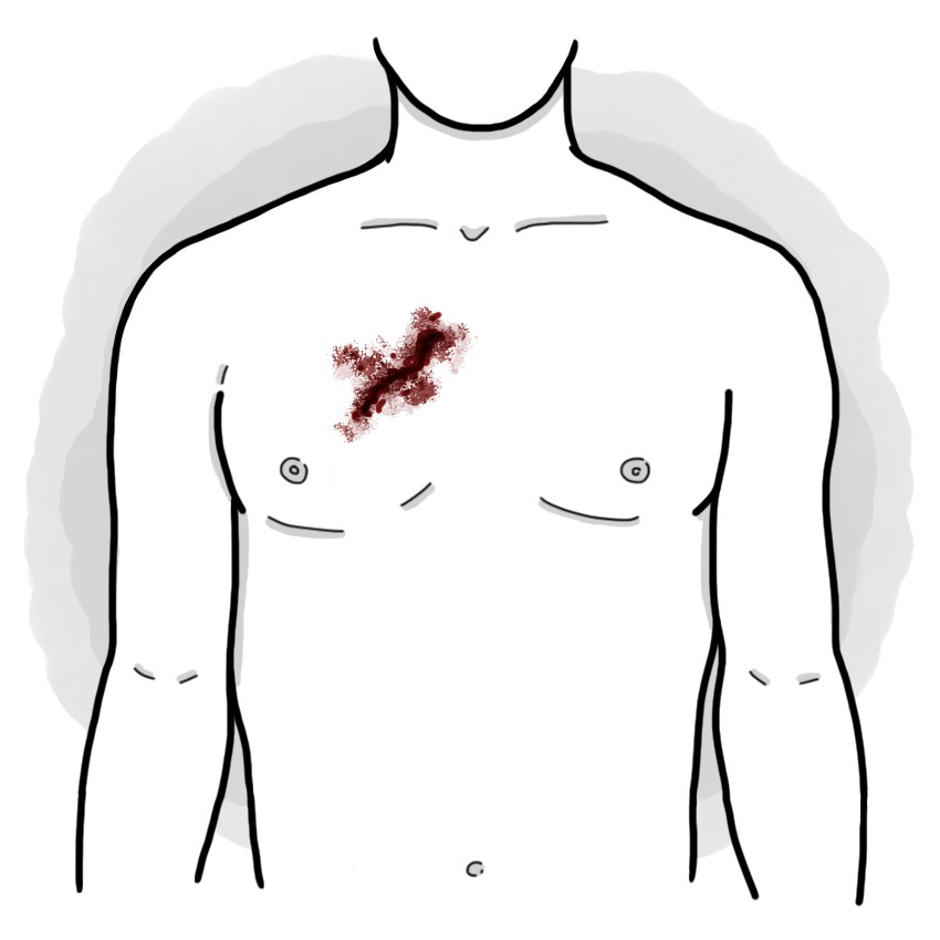 Thorax wound