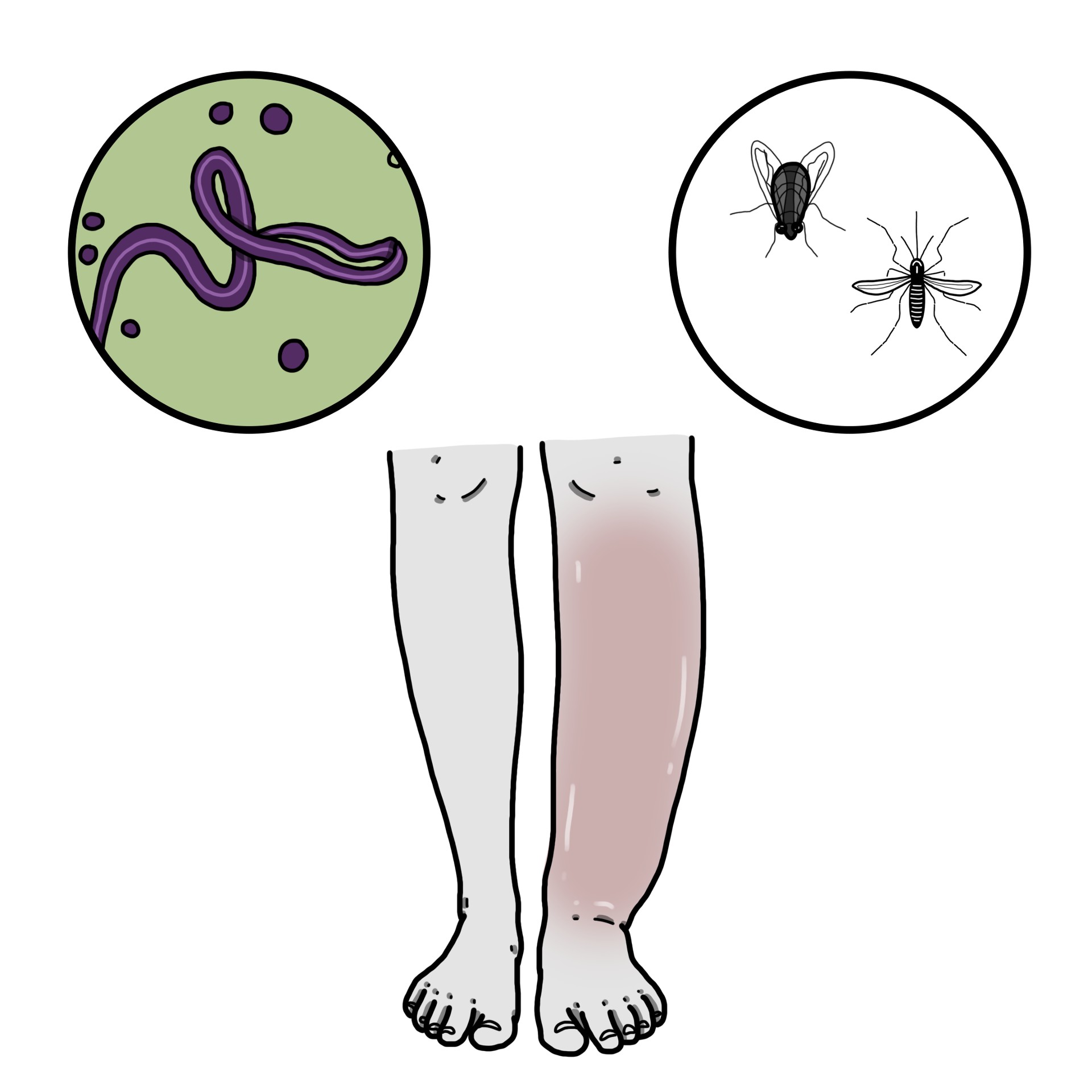 Lymphatic filariasis