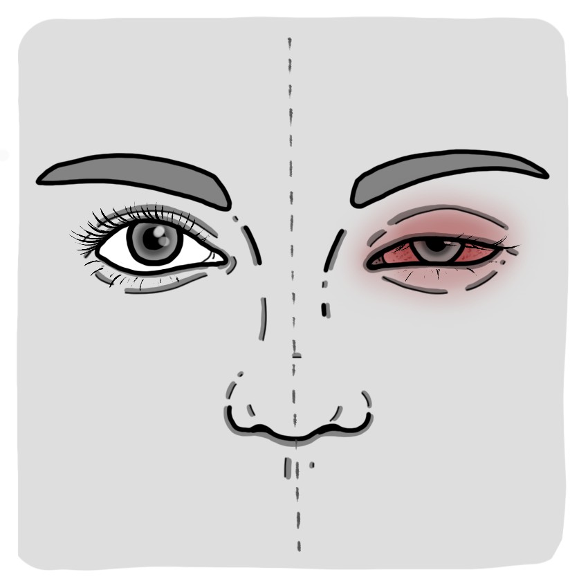 Viral conjunctivitis