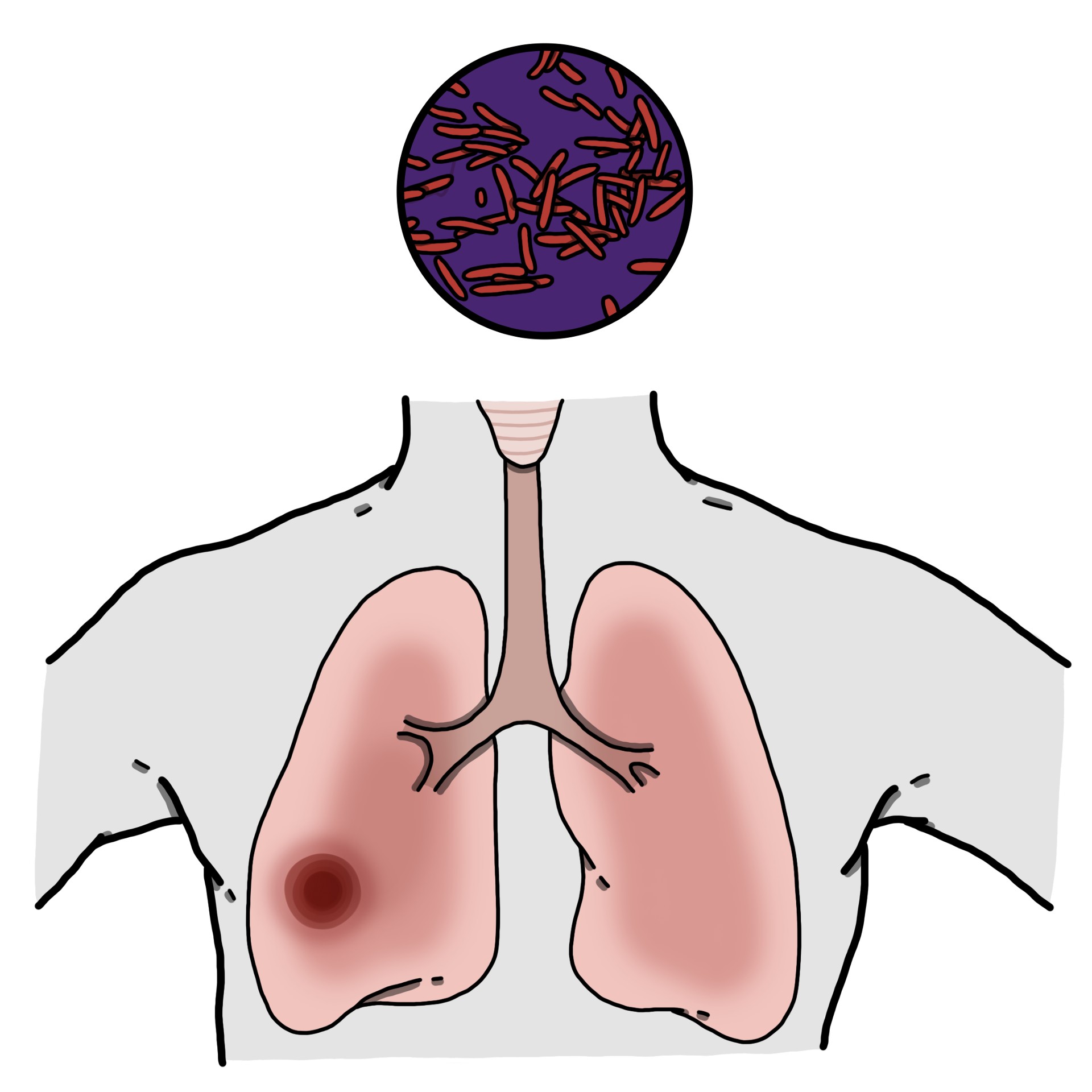 Pulmonary tuberculosis