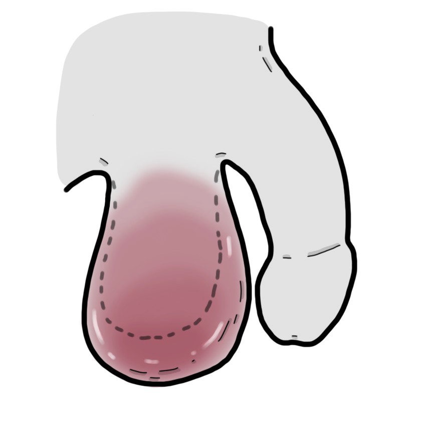 Escroto hinchado, caliente y enrojecido