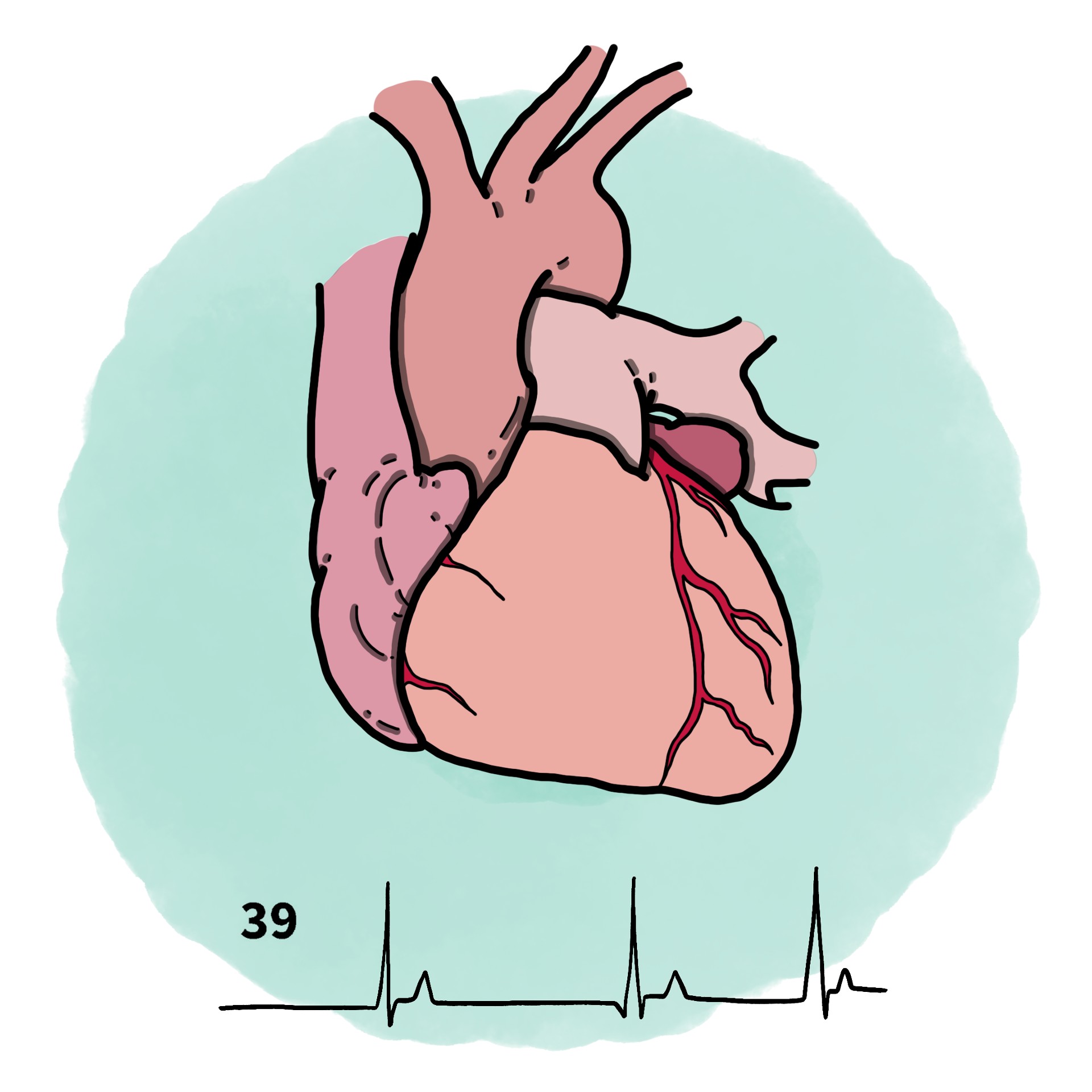 Slow cardiac arrhythmia - Bradyarrhythmia