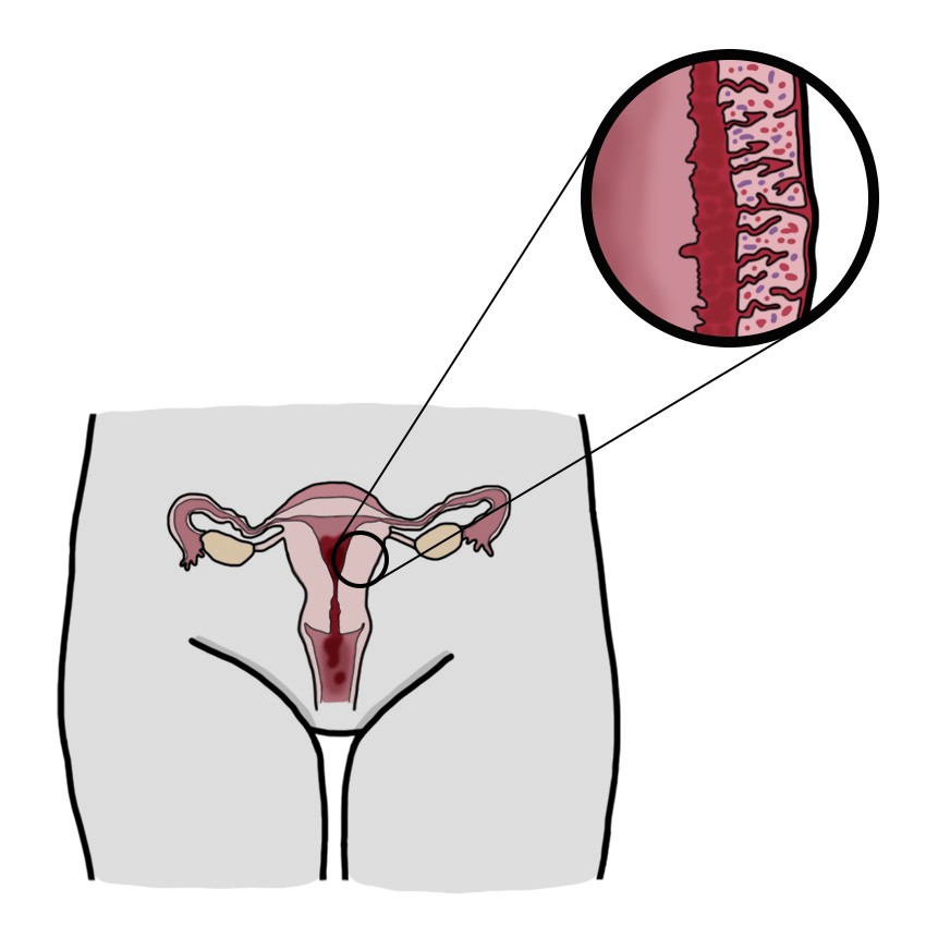 Hemorrhage after giving birth