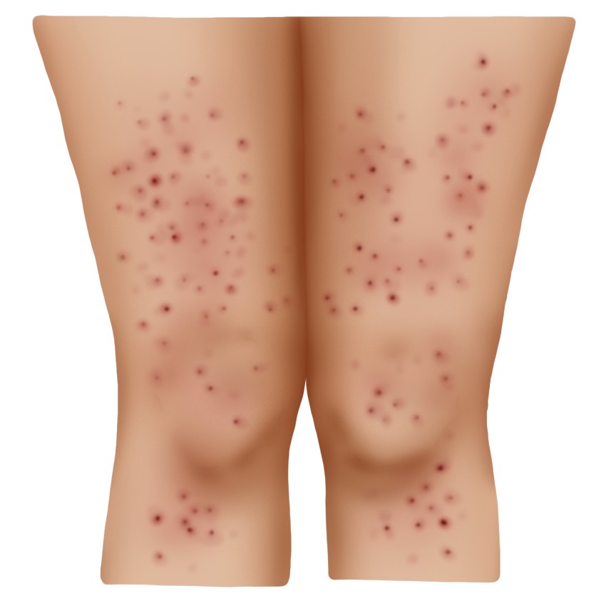 Polymorphic eruption of pregnancy