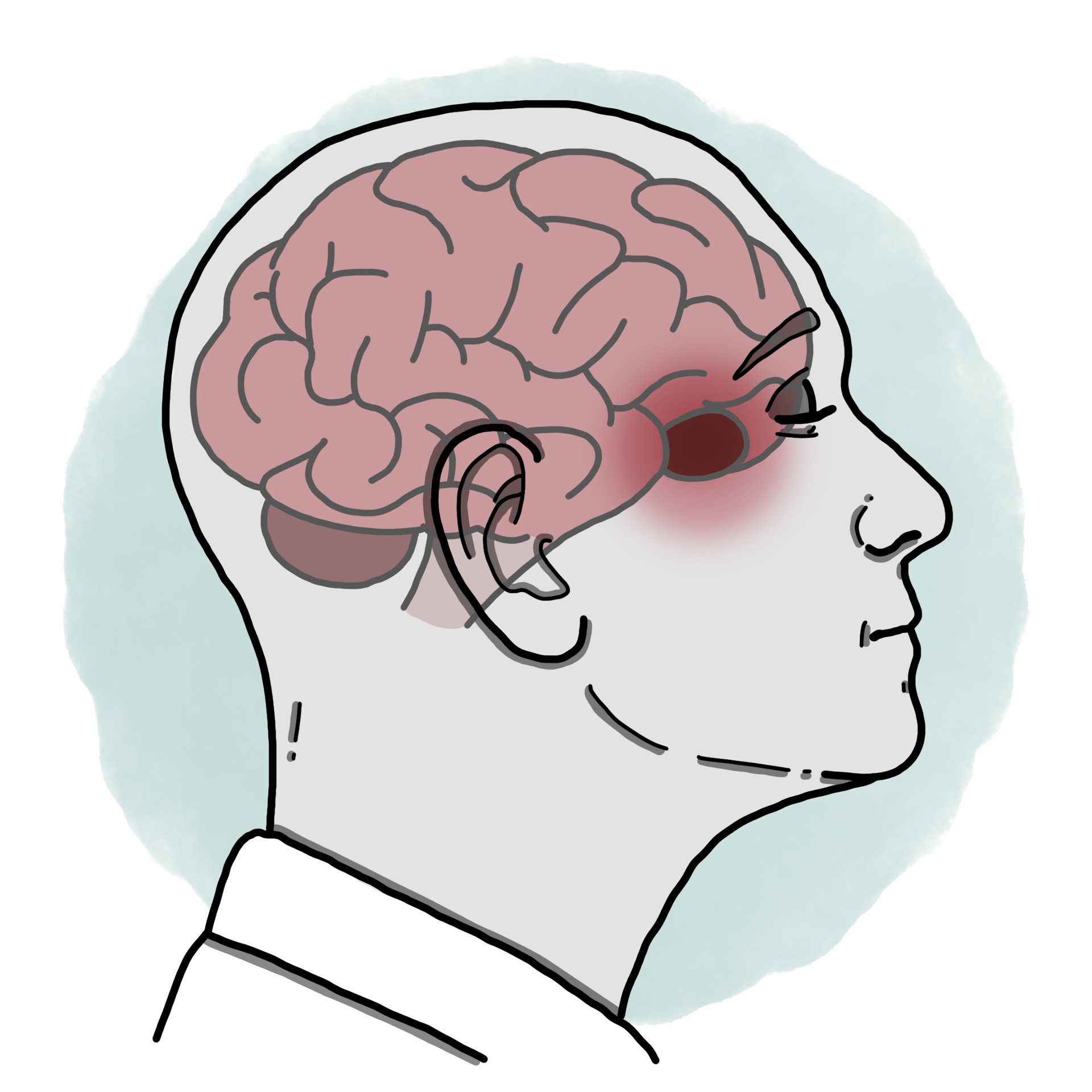 Brain abscess