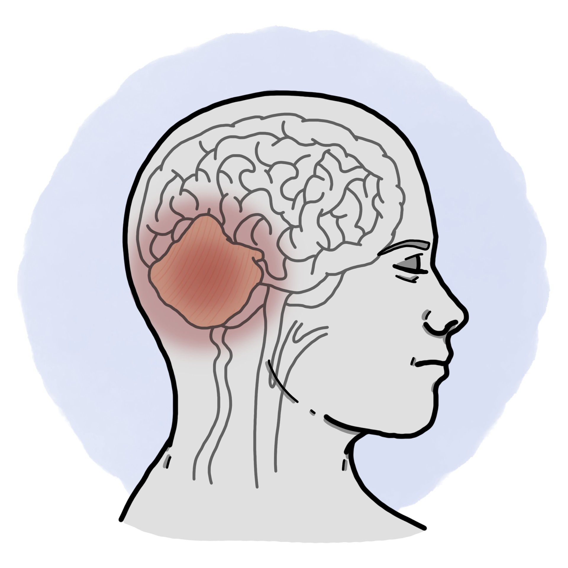 Acute postinfectious cerebellitis (Paediatrics)