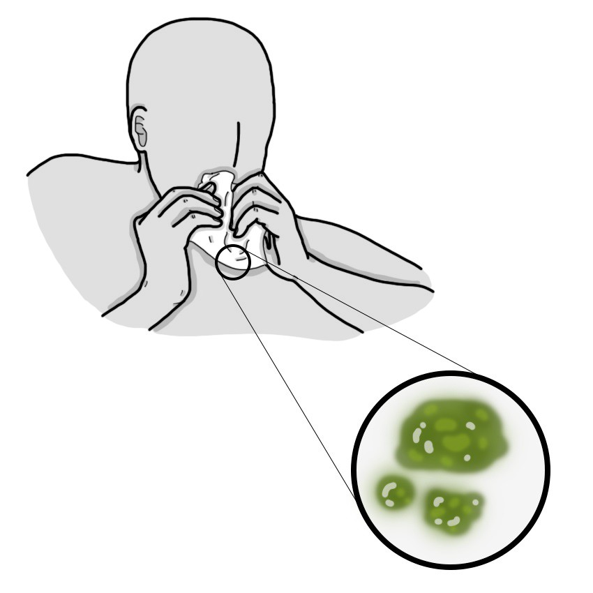 Πράσινες μύξες στη μύτη