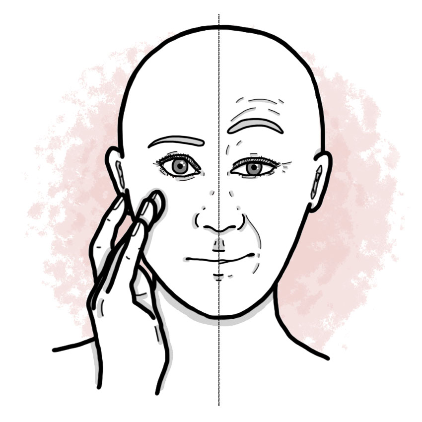 Peripheral facial palsy