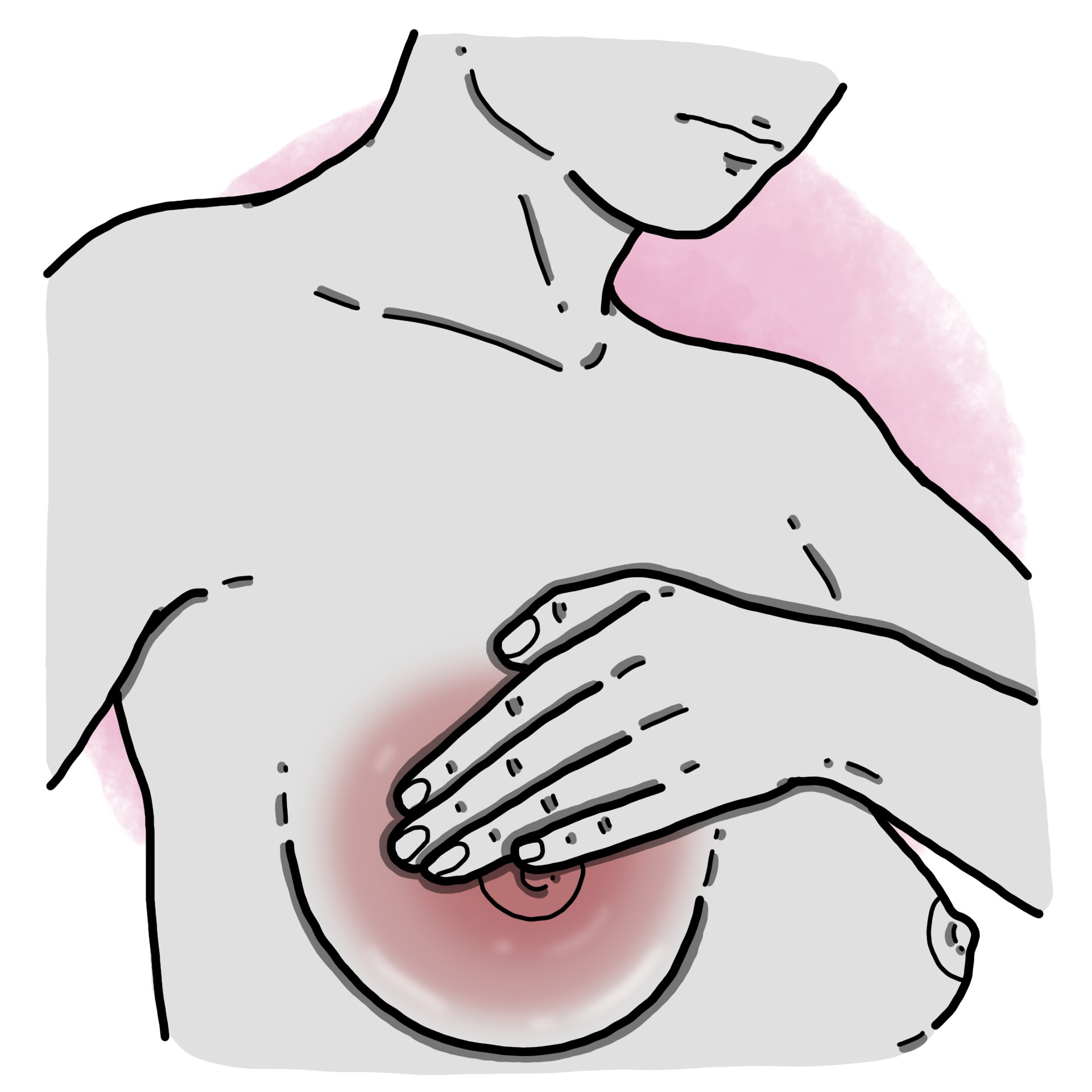 Mastitis - Non-puerperal mastitis