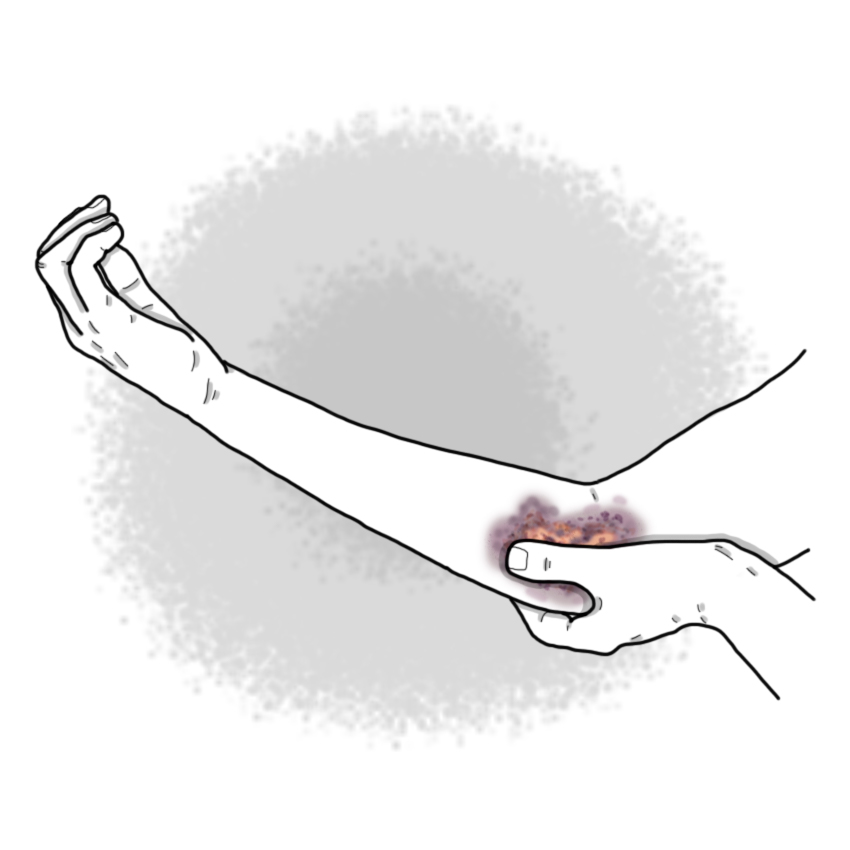 Elbow trauma - Elbow contusion