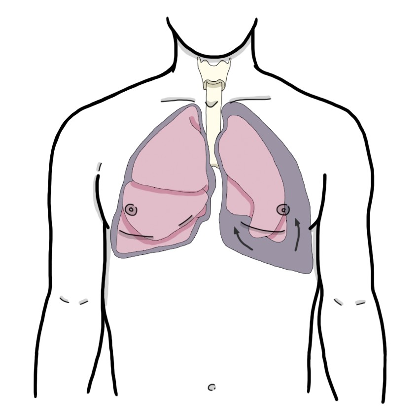 Pneumothorax