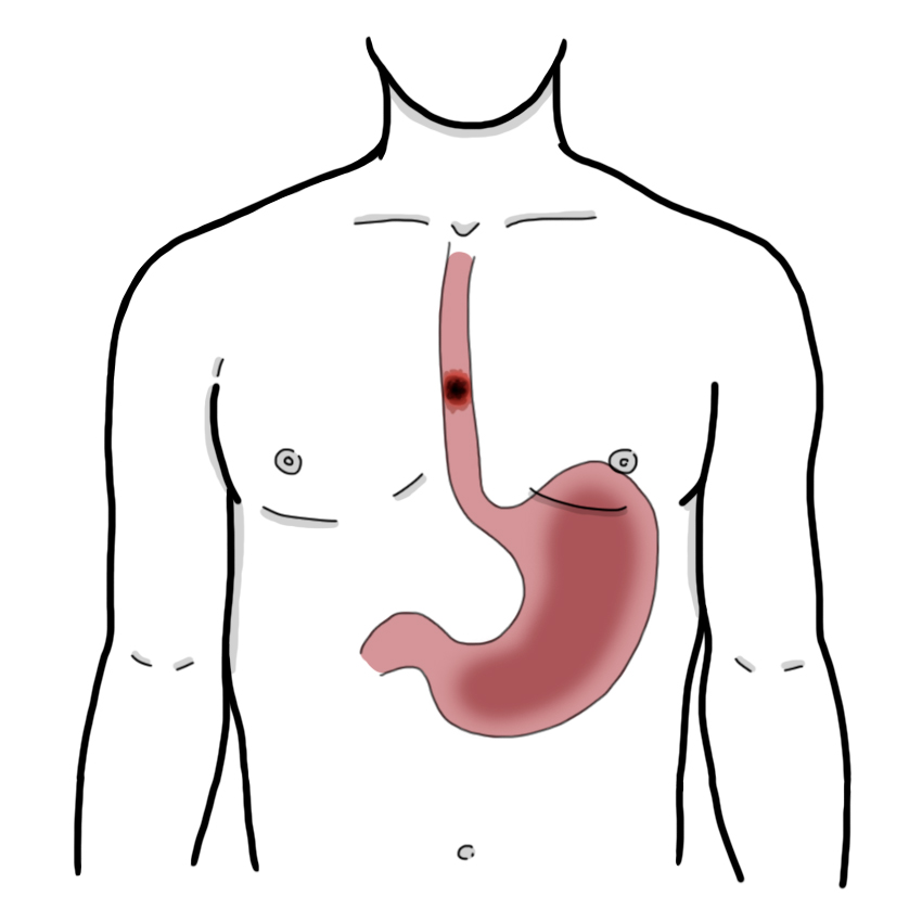 Oesophageal perforation