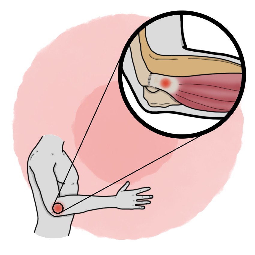 Tennis elbow - Epicondylitis