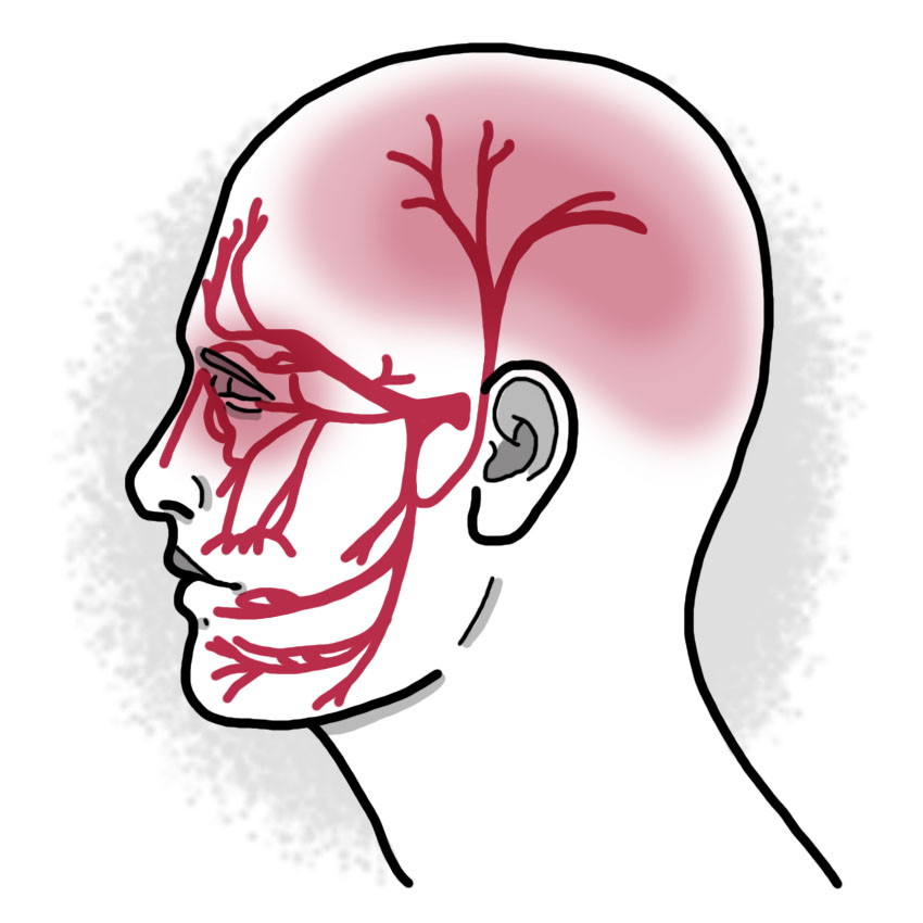 Trigeminal neuralgia