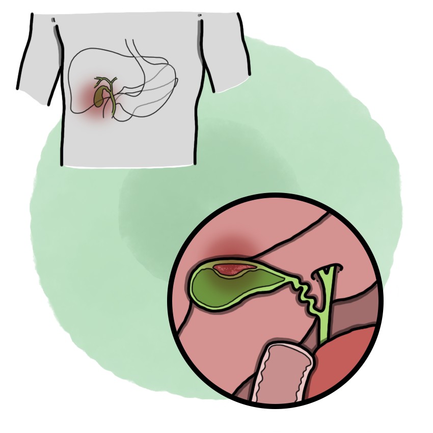Bile duct cancer - Cholangiocarcinoma