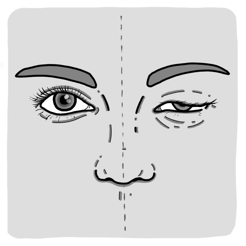 Miller-Fisher syndrome