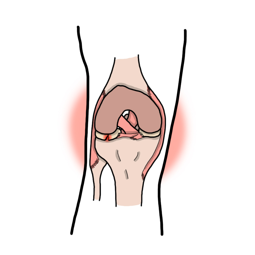 Blessure au ménisque