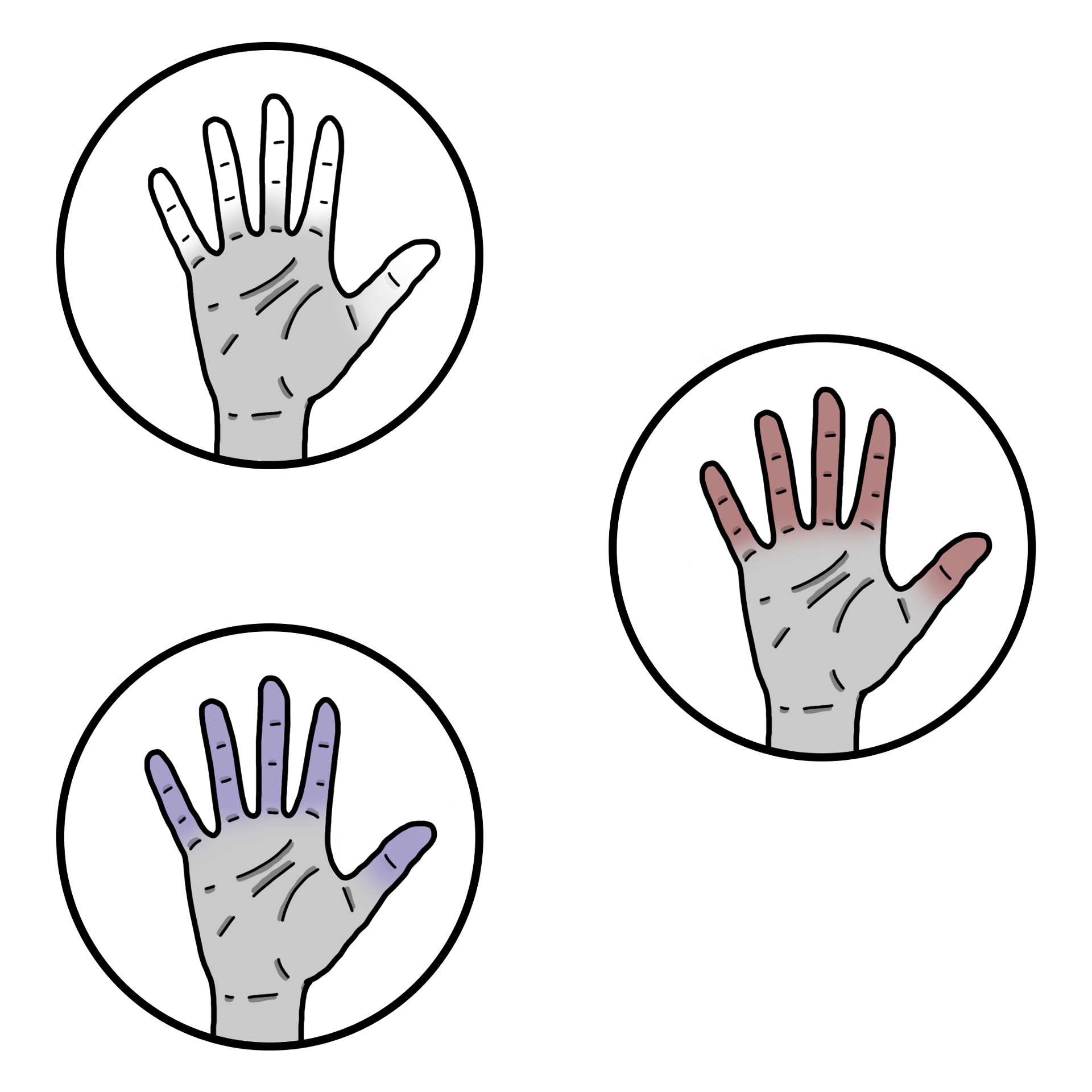Fenómeno de Raynaud