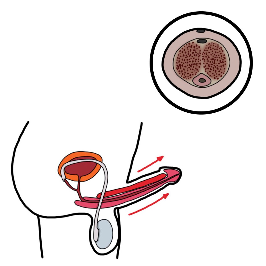 Erection due to a venous cause - Venous priapism
