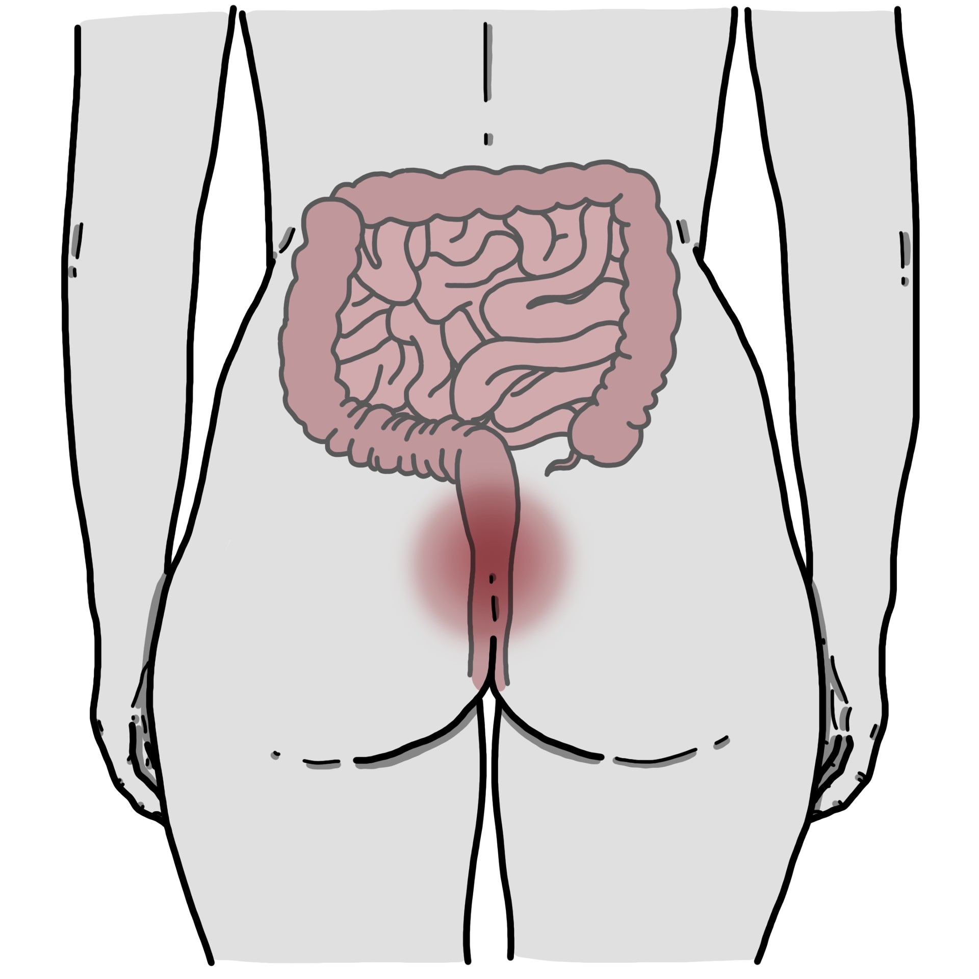 Dolor rectal
