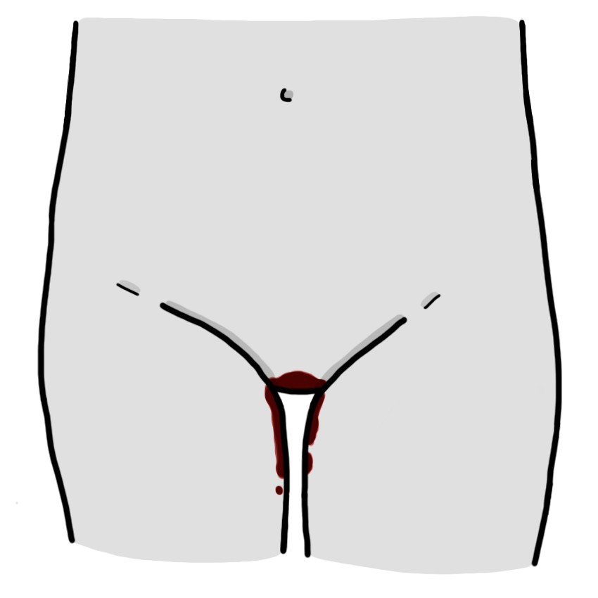 Sangre oscura por vagina