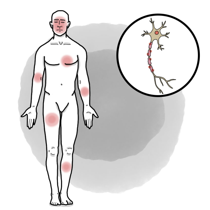 Guillain-Barré syndrome