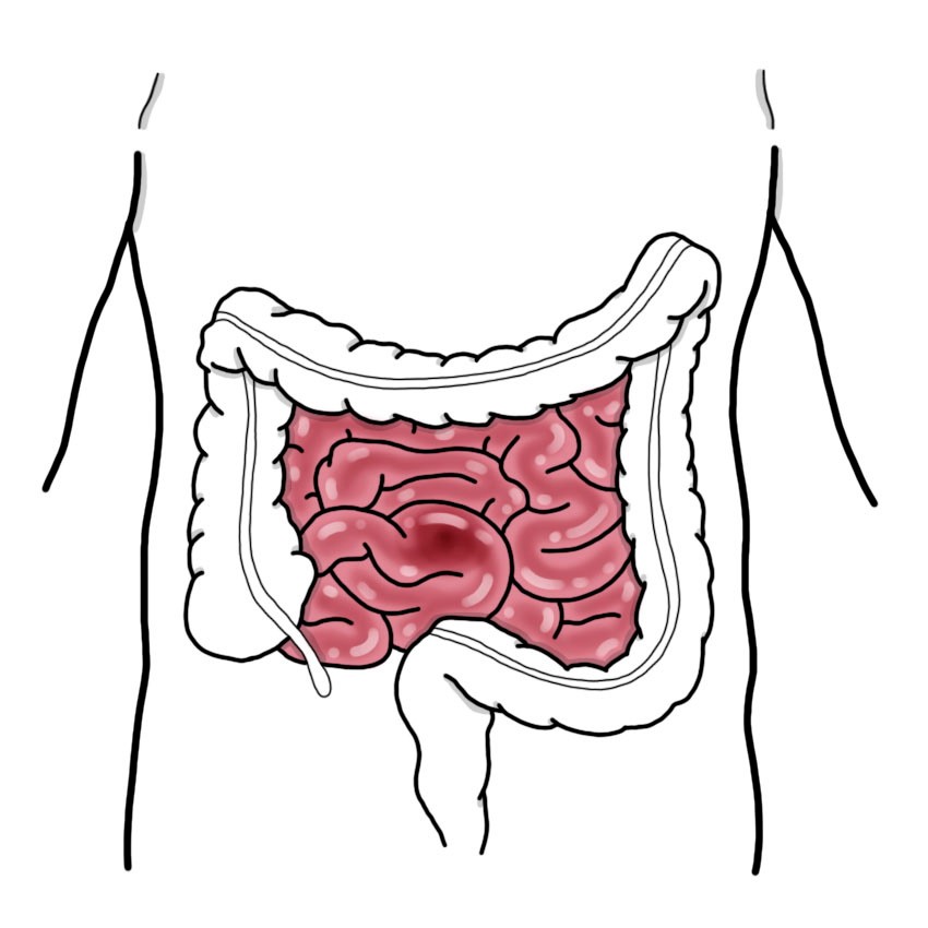 Intestinal obstruction due to loss of tone in the intestine - Paralytic ileus