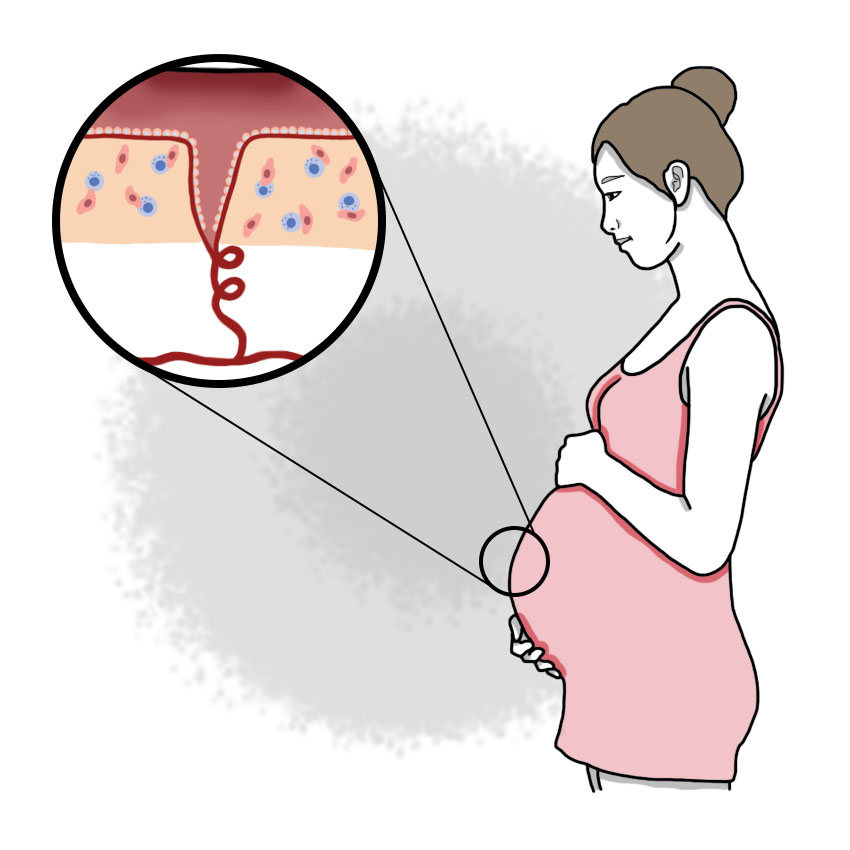 Preeclampsia