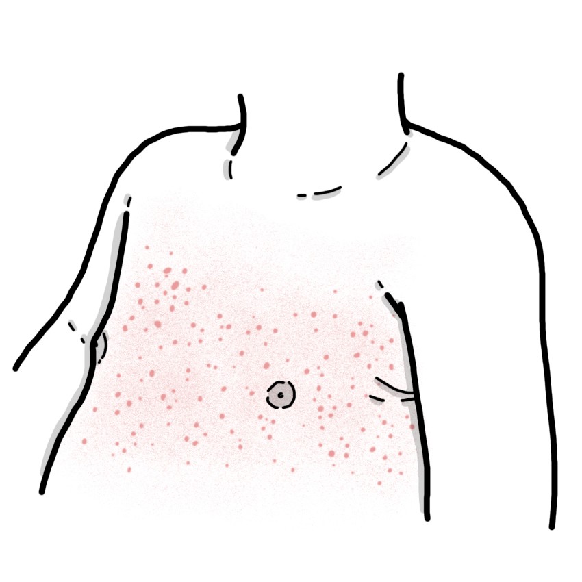 Sudden exanthema - Roseola infantum or 6th disease (Paediatrics)