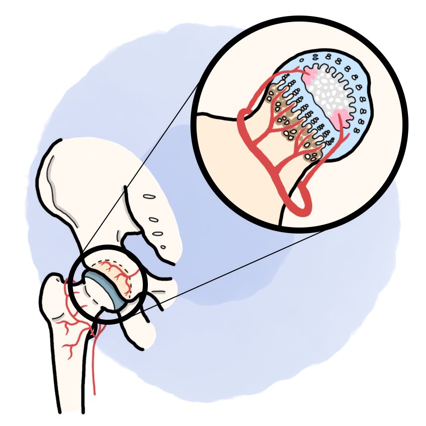 Perthes' disease - Legg-Calve-Perthes disease (Paediatrics)