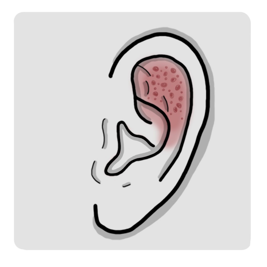 外耳に小水疱があります