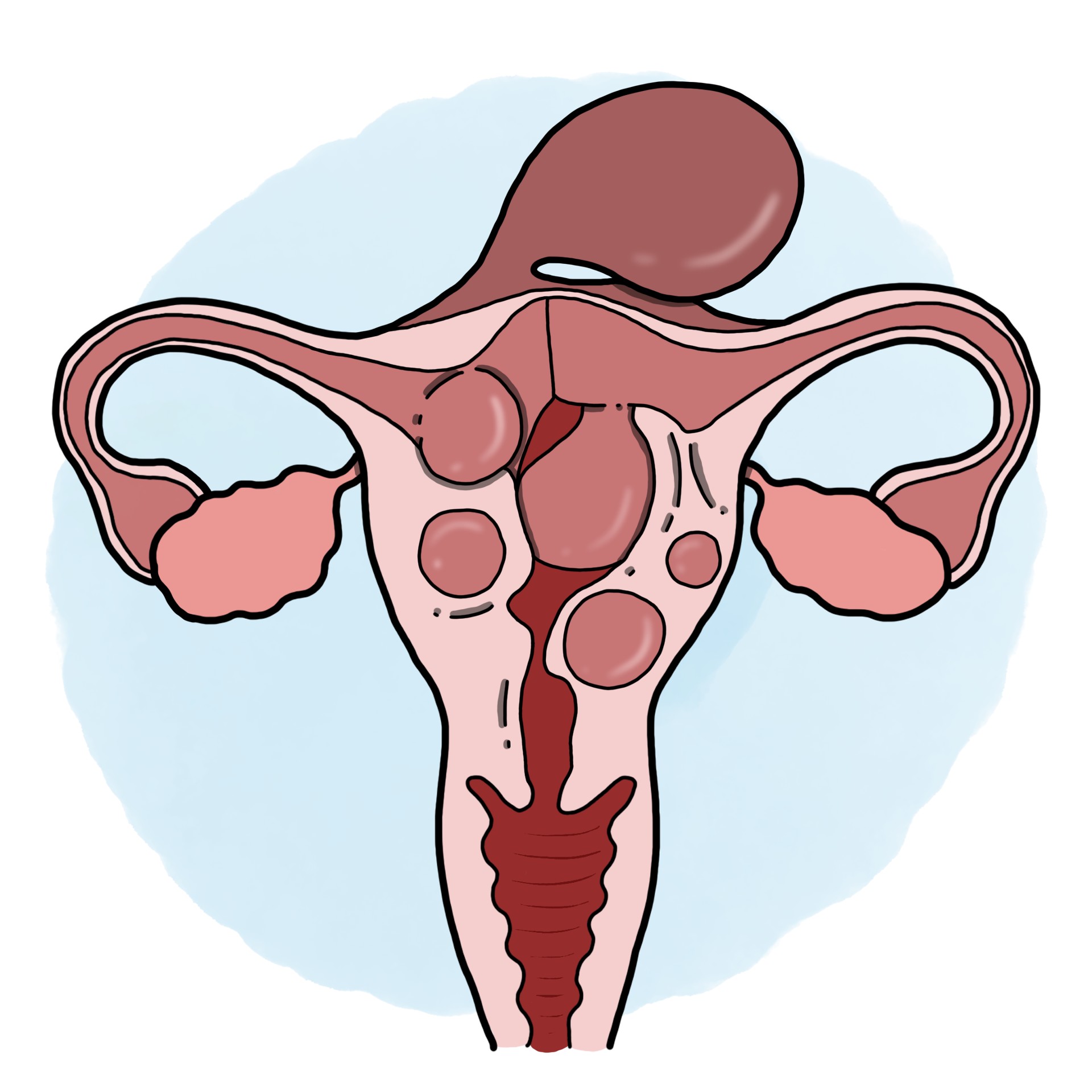 Complication of uterine myoma