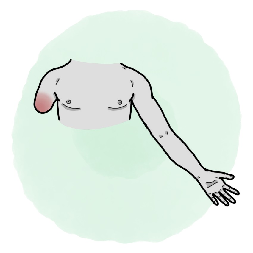 Arm amputation