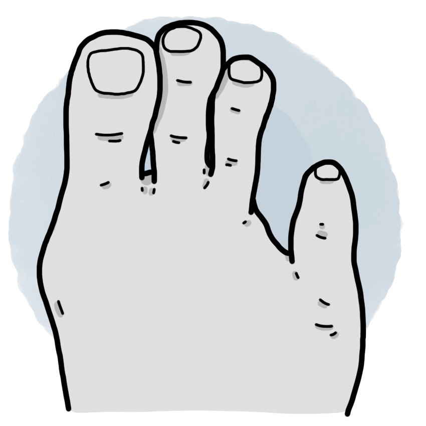 Fourth toe amputation