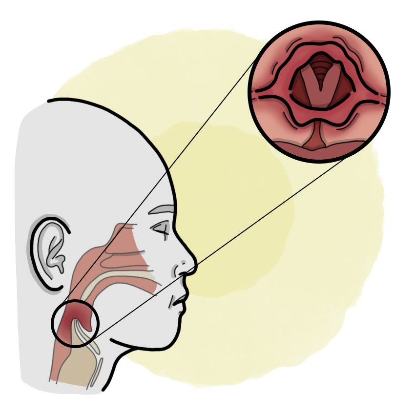 Epiglottitis (Paediatrics)