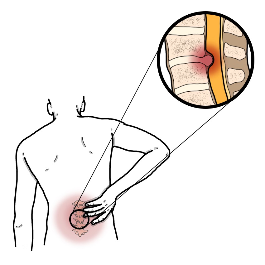Lumbar disc hernia - Lumbar radiculopathy due to a slipped disc