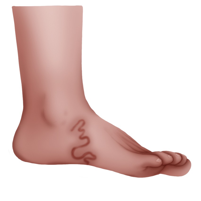 Cutaneous larva migrans