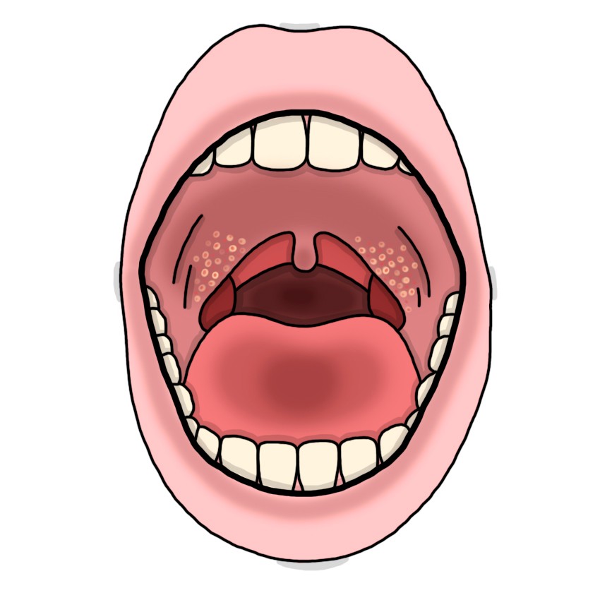 Herpangina (Paediatrics)