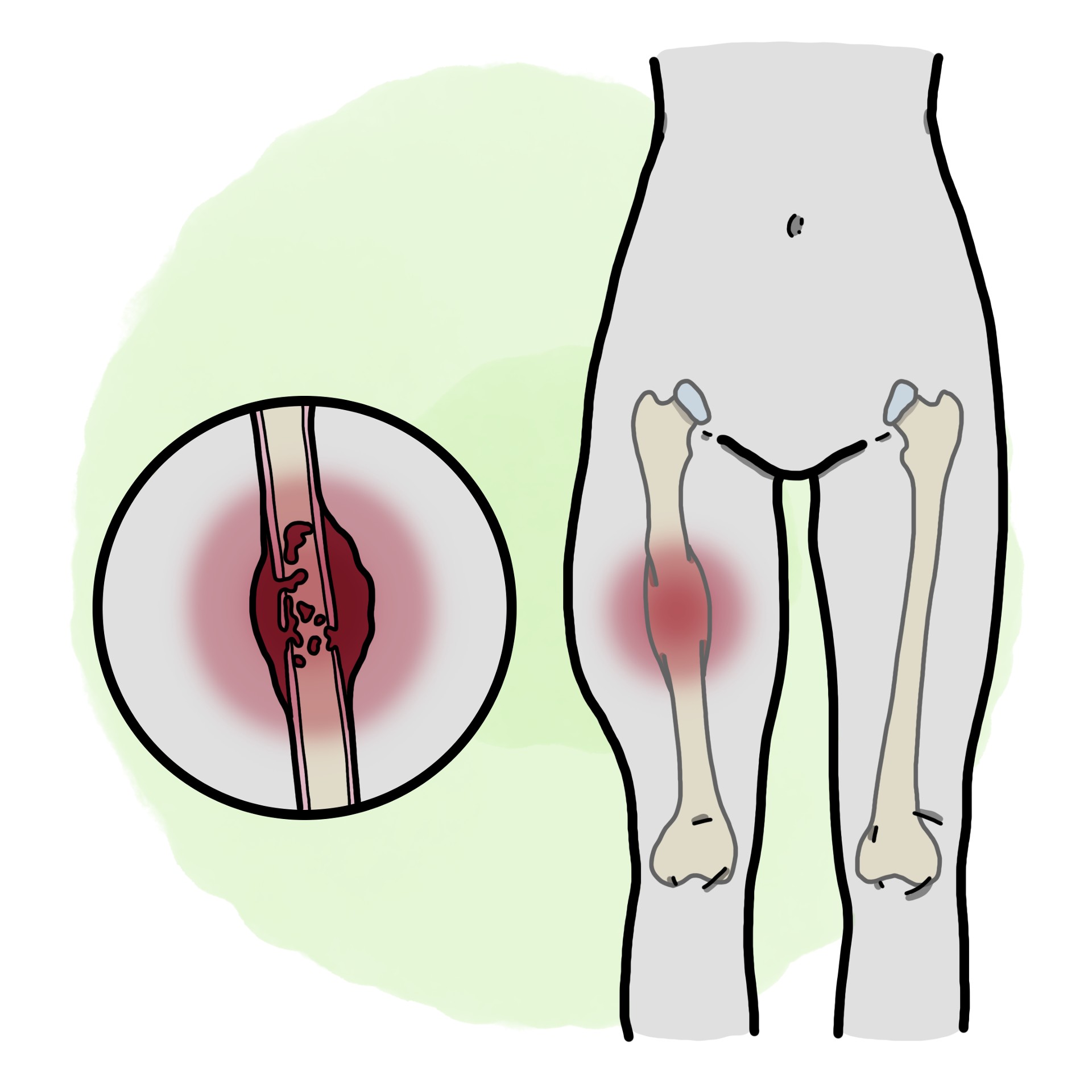Ewing's sarcoma (Paediatrics)