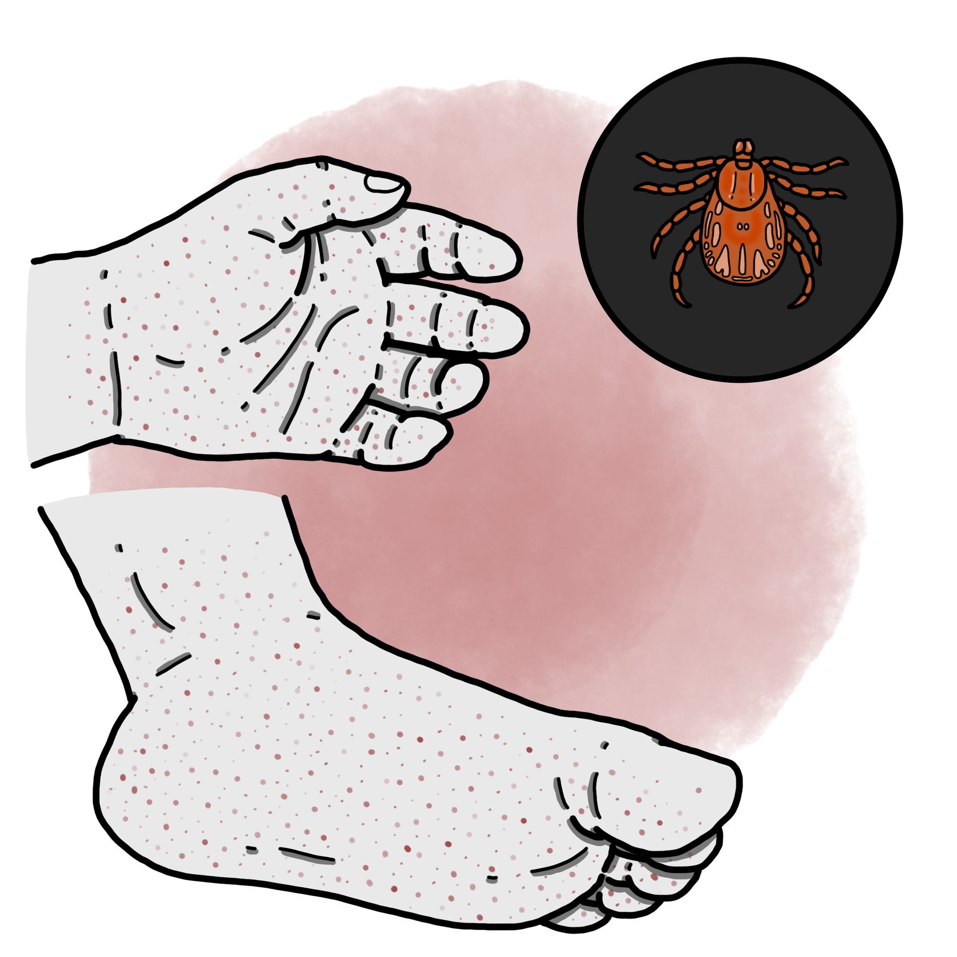 Rocky Mountain spotted fever - Rickettsiosis