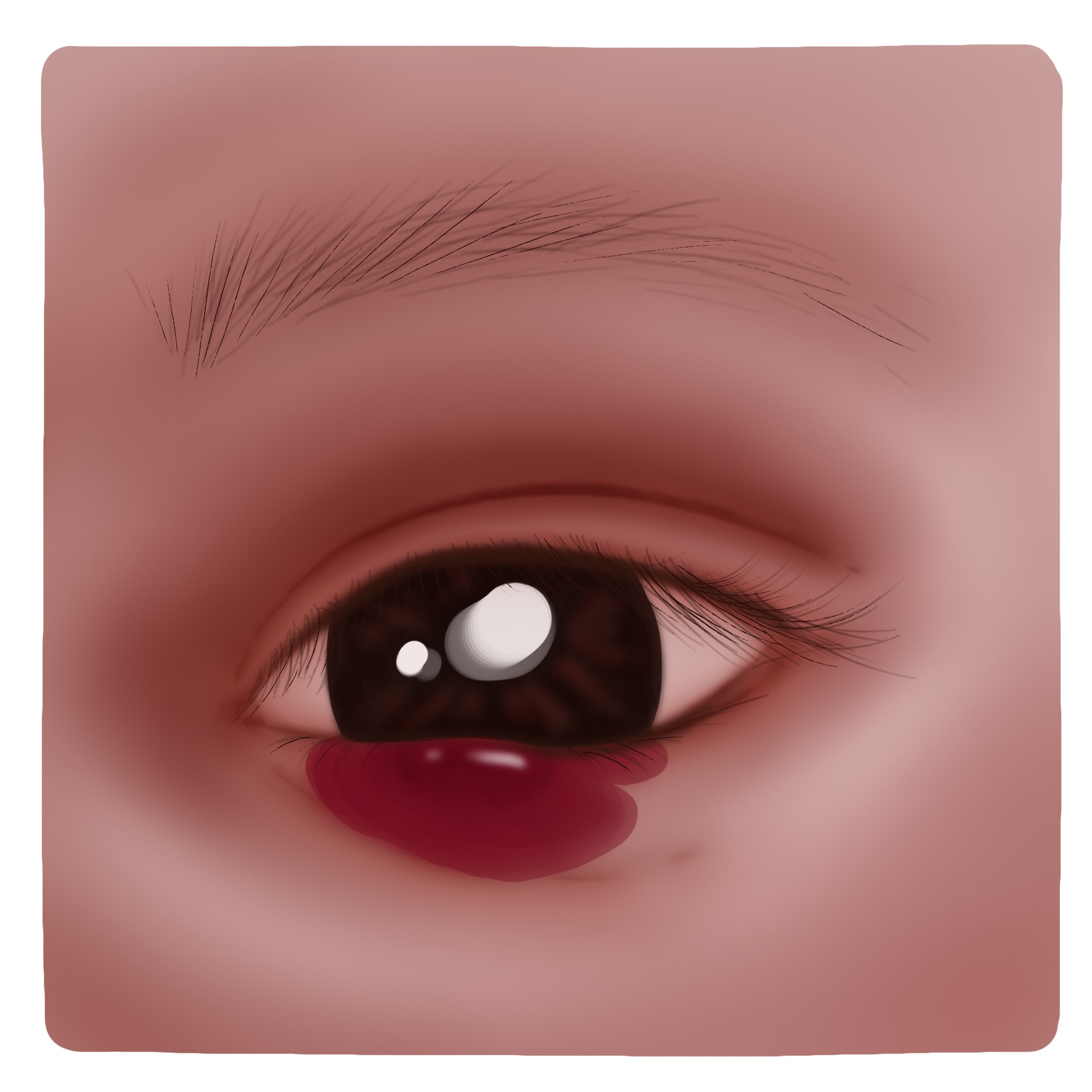 Haemangioma (Paediatrics)