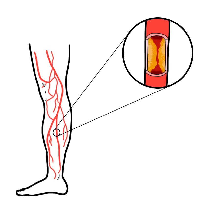 Critical chronic arterial ischaemia